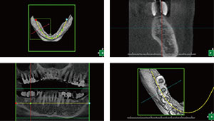 ＣＴによる正確なインプラント治療