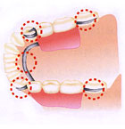 部分入れ歯