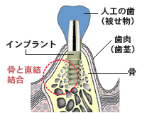 AQBインプラント