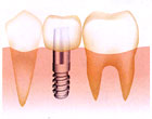 インプラント