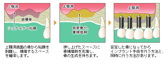 サイナスリフト法