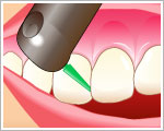 歯の隙間の清掃